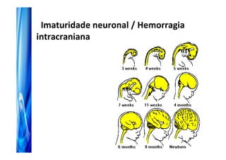 Imaturidade neuronal / Hemorragia
intracraniana
 