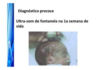 Diagnóstico precoce

Ultra-som de fontanela na 1a semana de
vida
 