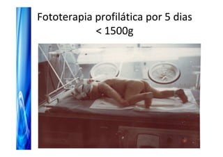 Fototerapia profilática por 5 dias
            < 1500g
 
