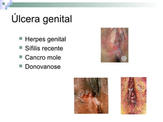 Úlcera genital
    Herpes genital
    Sífilis recente
    Cancro mole
    Donovanose
 