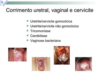 Corrimento uretral, vaginal e cervicite
            Uretrite/cervicite gonocócica
            Uretrite/cervicite não gonocócica
            Tricomoníase
            Candidíase
            Vaginose bacteriana
 
