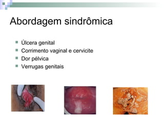 Abordagem sindrômica
    Úlcera genital
    Corrimento vaginal e cervicite
    Dor pélvica
    Verrugas genitais
 