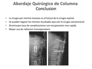 Conclusion
• La cirugia por minima invasion es el futuro de la cirugia espinal
• Se pueden logarar los mismos resultados que con la cirugia convencional
• Disminuyen tasa de complicaciones con recuperacion mas rapida
• Mayor uso de radiacion transoperatoria
 