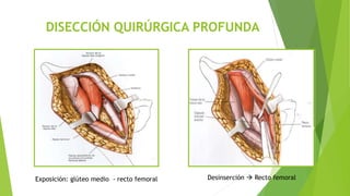 DISECCIÓN QUIRÚRGICA PROFUNDA
Exposición: glúteo medio - recto femoral Desinserción  Recto femoral
 