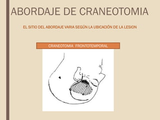 EL SITIO DEL ABORDAJE VARIA SEGÚN LA UBICACIÓN DE LA LESION
CRANEOTOMIA FRONTOTEMPORAL
ABORDAJE DE CRANEOTOMIA
 