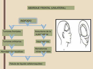 INDICADO
ABORDAJE FRONTAL (UNILATERAL)
Tumores frontales Aneurisma de la
a.pericallosa
traumatismo
Fistula de liquido cefalorraquídeo
Abordajes transcalloso
Hematomas
intracerebrales
Tumores orbitarios
 