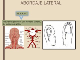 INDICADO
ABORDAJE LATERAL
Aneurismas pequeños y de mediano tamaño,
del polígono de Willis.
 