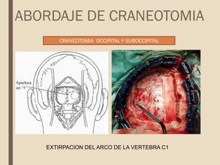 CRANEOTOMIA OCCIPITAL Y SUBOCCIPITAL
EXTIRPACION DEL ARCO DE LA VERTEBRA C1
ABORDAJE DE CRANEOTOMIA
 