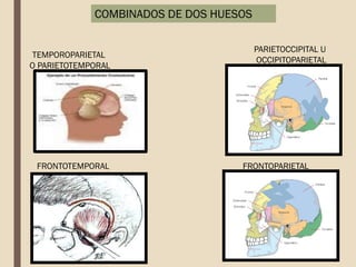 COMBINADOS DE DOS HUESOS
TEMPOROPARIETAL
O PARIETOTEMPORAL
PARIETOCCIPITAL U
OCCIPITOPARIETAL
FRONTOTEMPORAL FRONTOPARIETAL
 