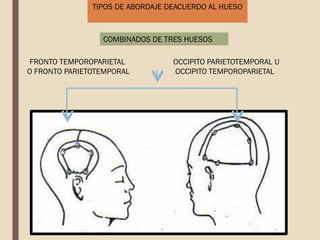 TIPOS DE ABORDAJE DEACUERDO AL HUESO
COMBINADOS DE TRES HUESOS
FRONTO TEMPOROPARIETAL
O FRONTO PARIETOTEMPORAL
OCCIPITO PARIETOTEMPORAL U
OCCIPITO TEMPOROPARIETAL
 