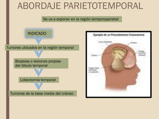 INDICADO
ABORDAJE PARIETOTEMPORAL
Se va a exponer en la región temporoparietal
Biopsias o lesiones propias
del lóbulo temporal
Lobectomía temporal
Tumores de la base media del cráneo
Tumores ubicados en la región temporal
 