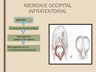 INDICADO
ABORDAJE OCCIPITAL
INFRATENTORIAL
Tumores del lóbulo occipital
Meningiomas
posterior del cerebro
Meningiomas con un
componente supratentorial
 