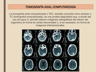 TOMOGRAFÍA AXIAL COMPUTARIZADA
La tomografía axial computarizada o TAC, también conocida como escáner o
TC (tomografía computarizada), es una prueba diagnóstica que, a través del
uso de rayos X, permite obtener imágenes radiográficas del interior del
organismo en forma de cortes trasversales o, si es necesario, en forma de
imágenes tridimensionales.
 
