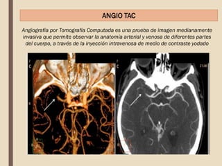 Angiografía por Tomografía Computada es una prueba de imagen medianamente
invasiva que permite observar la anatomía arterial y venosa de diferentes partes
del cuerpo, a través de la inyección intravenosa de medio de contraste yodado
ANGIO TAC
 
