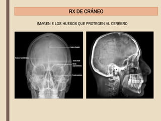 IMAGEN E LOS HUESOS QUE PROTEGEN AL CEREBRO
RX DE CRÁNEO
 