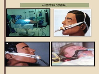 ANESTESIA GENERAL
 