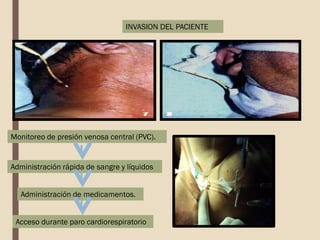 INVASION DEL PACIENTE
Monitoreo de presión venosa central (PVC).
Administración rápida de sangre y líquidos
Acceso durante paro cardiorespiratorio
Administración de medicamentos.
 