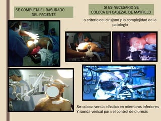 SE COMPLETA EL RASURADO
DEL PACIENTE
SI ES NECESARIO SE
COLOCA UN CABEZAL DE MAYFIELD
a criterio del cirujano y la complejidad de la
patología
Se coloca venda elástica en miembros inferiores
Y sonda vesical para el control de diuresis
 
