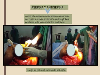 ASEPSIA Y ANTISEPSIA
sobre el cráneo completamente rasurado
se realiza previa protección de los globos
oculares y de los conductos auditivos
Luego se retira el exceso de solución
 