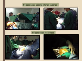 Colocación de sabana inferior, superior
Colocación de fenestrado
 