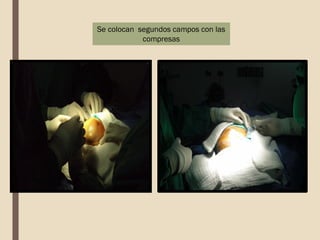 Se colocan segundos campos con las
compresas
 