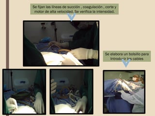 Se fijan las líneas de succión , coagulación , corte y
motor de alta velocidad. Se verifica la intensidad.
Se elabora un bolsillo para
Introducir los cables
 