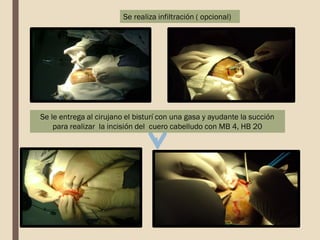 Se realiza infiltración ( opcional)
Se le entrega al cirujano el bisturí con una gasa y ayudante la succión
para realizar la incisión del cuero cabelludo con MB 4, HB 20
 