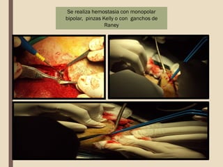 Se realiza hemostasia con monopolar
bipolar, pinzas Kelly o con ganchos de
Raney
 