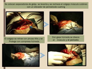 Se colocan separadores de gelpy se levanta y se rechaza el colgajo músculo cutáneo
con un elevador de periostiode cushing
Con gasa húmeda se diseca
el músculo y el periostio
El colgajo se retrae con pinzas Allis y se
Protege con compresa húmeda
 
