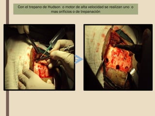 Con el trepano de Hudson o motor de alta velocidad se realizan uno o
mas orificios o de trepanación
 
