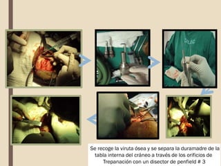 Se recoge la viruta ósea y se separa la duramadre de la
tabla interna del cráneo a través de los orificios de
Trepanación con un disector de penfield # 3
 