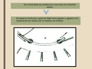 Se pasa el conductor o guía de Gigli entre agujero y agujero si la
trepanación se realizó con el trepano de Hudson
La viruta ósea se conserva en una coca con solución
salina.
 