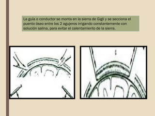 La guía o conductor se monta en la sierra de Gigli y se secciona el
puento óseo entre los 2 agujeros irrigando constantemente con
solución salina, para evitar el calentamiento de la sierra.
 