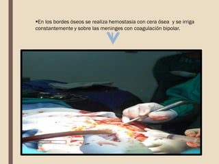 En los bordes óseos se realiza hemostasia con cera ósea y se irriga
constantemente y sobre las meninges con coagulación bipolar.
 