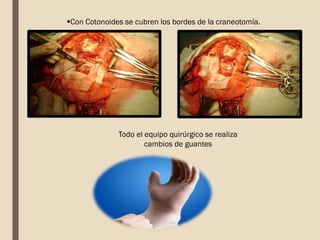 Con Cotonoides se cubren los bordes de la craneotomía.
Todo el equipo quirúrgico se realiza
cambios de guantes
 
