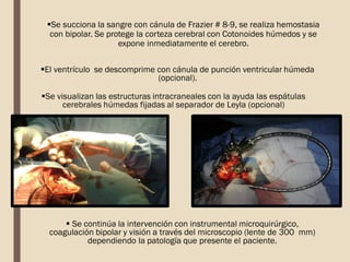 Se succiona la sangre con cánula de Frazier # 8-9, se realiza hemostasia
con bipolar. Se protege la corteza cerebral con Cotonoides húmedos y se
expone inmediatamente el cerebro.
El ventrículo se descomprime con cánula de punción ventricular húmeda
(opcional).
Se visualizan las estructuras intracraneales con la ayuda las espátulas
cerebrales húmedas fijadas al separador de Leyla (opcional)
 Se continúa la intervención con instrumental microquirúrgico,
coagulación bipolar y visión a través del microscopio (lente de 300 mm)
dependiendo la patología que presente el paciente.
 