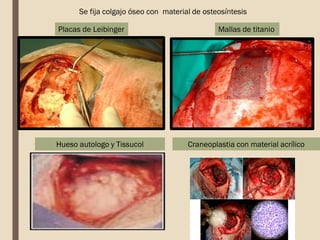 Se fija colgajo óseo con material de osteosíntesis
Hueso autologo y Tissucol Craneoplastia con material acrílico
Mallas de titanio
Placas de Leibinger
 