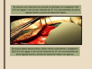 Se suturan los músculos de acuerdo al abordaje con poliglactin 910
2/0 con aguja ½ de circulo redonda de 37 mm acompañado de porta
agujas fuerte y pinzas de disección Adson.
Se sutura gálea aponeurótica, tejido celular subcutáneo y poliglactin
910 2/0 con aguja ½ de circulo redonda de 37 mm acompañado de
porta agujas fuerte y pinzas de disección Adson con garras.
 