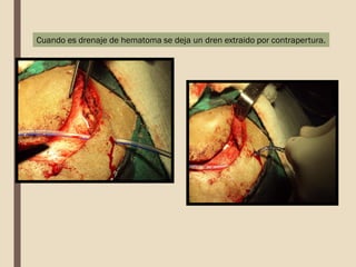 Cuando es drenaje de hematoma se deja un dren extraido por contrapertura.
 