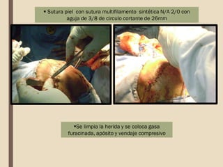  Sutura piel con sutura multifilamento sintética N/A 2/0 con
aguja de 3/8 de circulo cortante de 26mm
Se limpia la herida y se coloca gasa
furacinada, apósito y vendaje compresivo
 