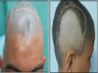 ABORDAJE DE CRANEOTOMIA.pdf