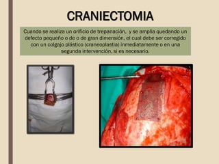 Cuando se realiza un orificio de trepanación, y se amplia quedando un
defecto pequeño o de o de gran dimensión, el cual debe ser corregido
con un colgajo plástico (craneoplastia) inmediatamente o en una
segunda intervención, si es necesario.
CRANIECTOMIA
 