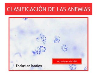 CLASIFICACIÓN DE LAS ANEMIAS




                Inclusiones de HbH
 