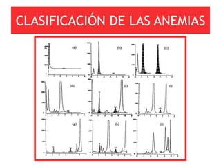 CLASIFICACIÓN DE LAS ANEMIAS
 