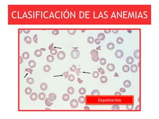 CLASIFICACIÓN DE LAS ANEMIAS




                 Esquistocitos
 