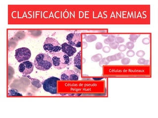 CLASIFICACIÓN DE LAS ANEMIAS




                               Células de Rouleaux


           Células de pseudo
              Pelger Huet
 