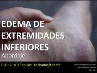 EDEMA DE
EXTREMIDADES
INFERIORES
Dr. Hiram O. Martín De Mera
MR2 Medicina Familiar
CSS - UP
Abordaje
CIAP-2: K07 Tobillos Hinchados/Edema
 