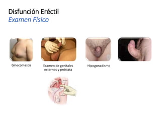 Disfunción Eréctil
Examen Físico
Ginecomastia Examen de genitales
externos y próstata
Hipogonadismo
 