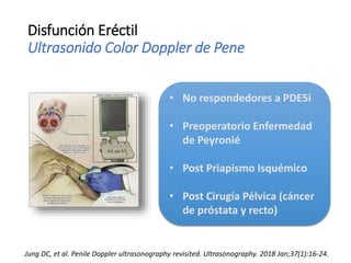 Disfunción Eréctil
Ultrasonido Color Doppler de Pene
• No respondedores a PDE5i
• Preoperatorio Enfermedad
de Peyronié
• Post Priapismo Isquémico
• Post Cirugía Pélvica (cáncer
de próstata y recto)
Jung DC, et al. Penile Doppler ultrasonography revisited. Ultrasonography. 2018 Jan;37(1):16-24.
 