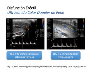 Disfunción Eréctil
Ultrasonido Color Doppler de Pene
PSV < 25 cm/s insuficiencia
arterial cavernosa
EDV > 5 cm/s disfunción
veno-oclusiva
Jung DC, et al. Penile Doppler ultrasonography revisited. Ultrasonography. 2018 Jan;37(1):16-24.
 